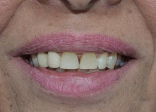 Original -smile-diffrence