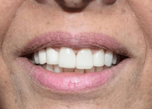 Processed - smile-diffrence