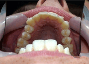 Processed - smile-diffrence