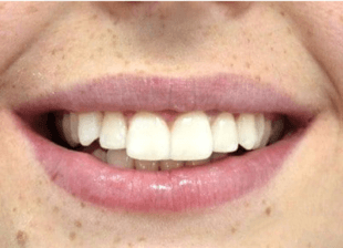 Processed - smile-diffrence