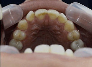 Original -smile-diffrence