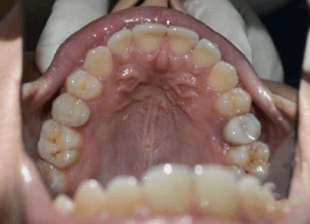 Processed - smile-diffrence