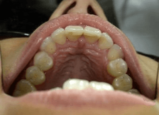 Processed - smile-diffrence