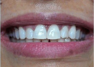 Processed - smile-diffrence