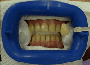 Original -smile-diffrence