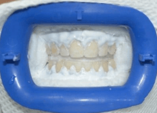 Processed - smile-diffrence