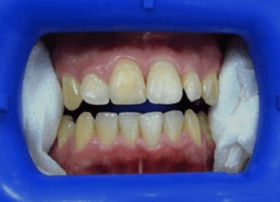 Original -smile-diffrence