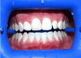 Processed - smile-diffrence