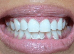 Processed - smile-diffrence