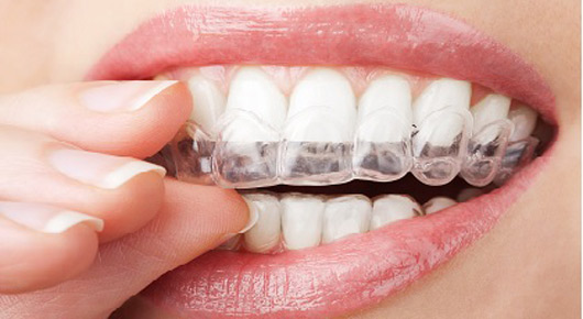 Home-Whitening-Tray