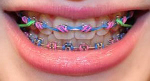 braces-color