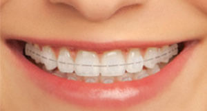 ceramicbraces
