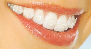 clear-braces