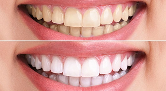 teeth-whitening